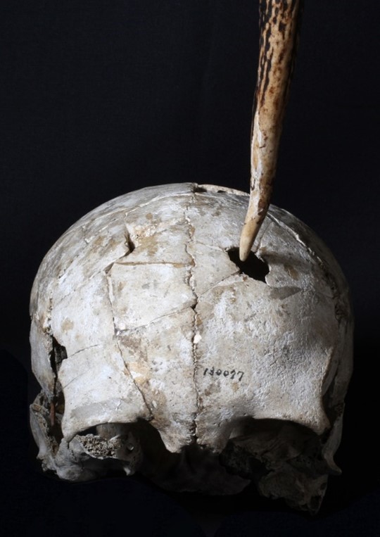 破壊的に突かれた縄文人の頭骨を発見